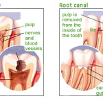 dental-pulp-root-canal