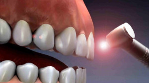 Exceptional Benefits of Laser Root Canal Therapy