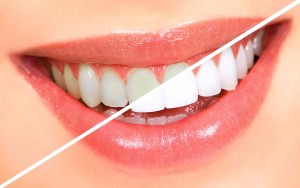 5Ws of Teeth Whitening