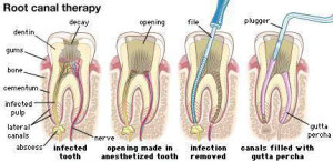 Why Get Root Canal Treatment