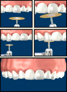 Reshape Teeth thru Enamel Shaping Treatment