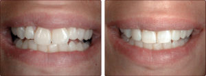 Reshape Teeth thru Enamel Shaping Treatment.1jpg
