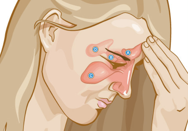 How Sinusitis Affects You